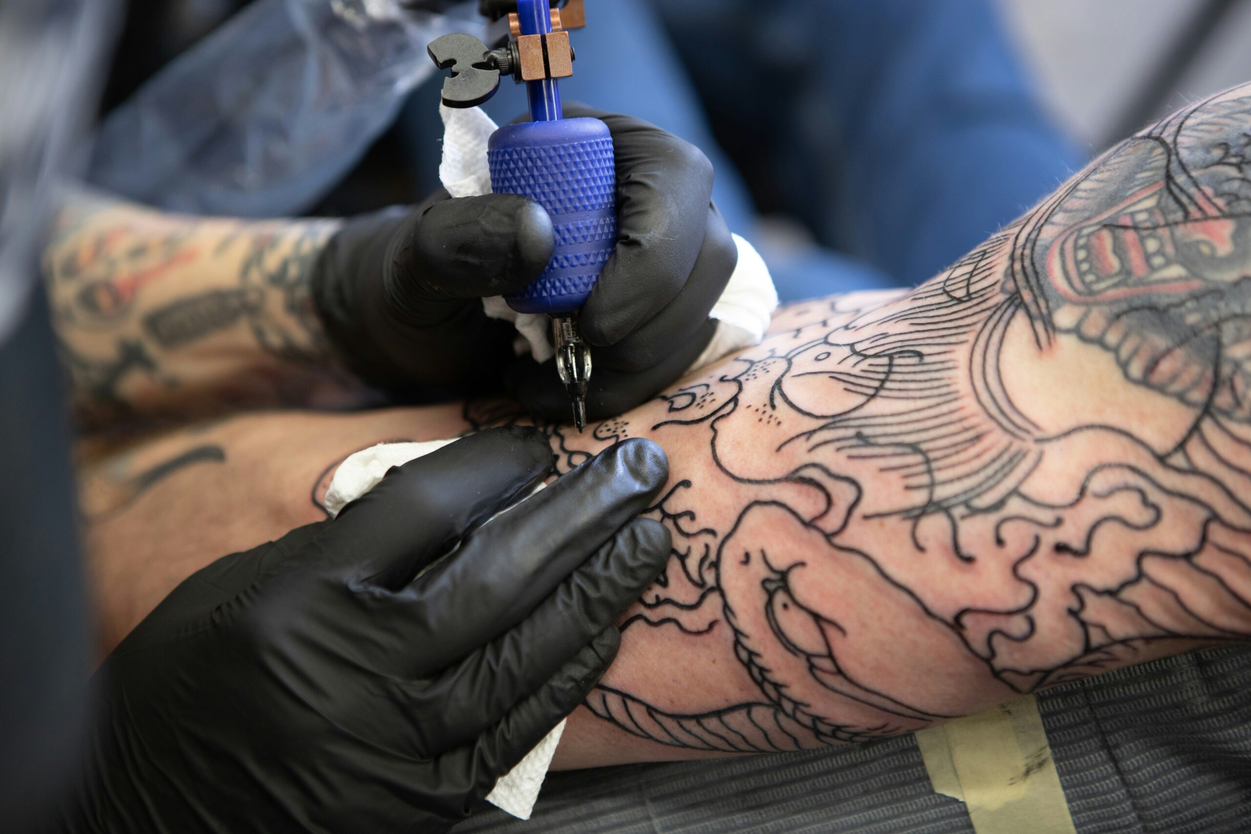tattoo removal